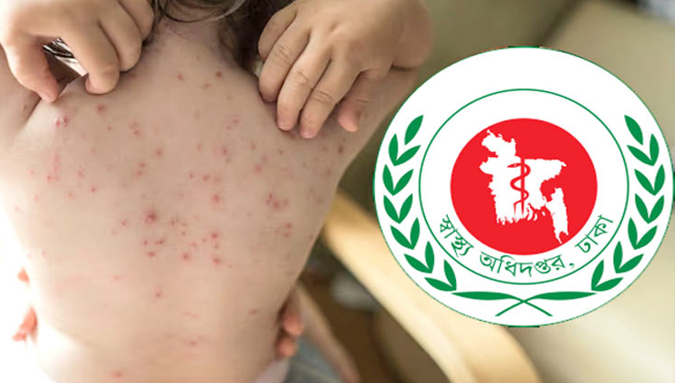 হামে আরও ৭ শিশুর মৃত্যু