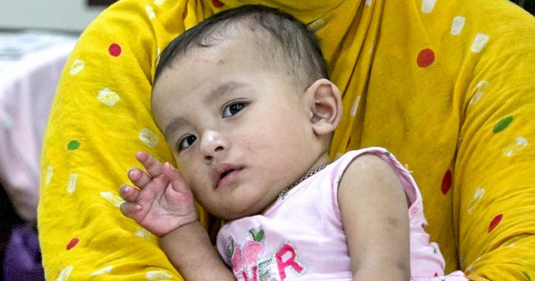 হাম উপসর্গে আরও ৫ শিশুর মৃত্যু